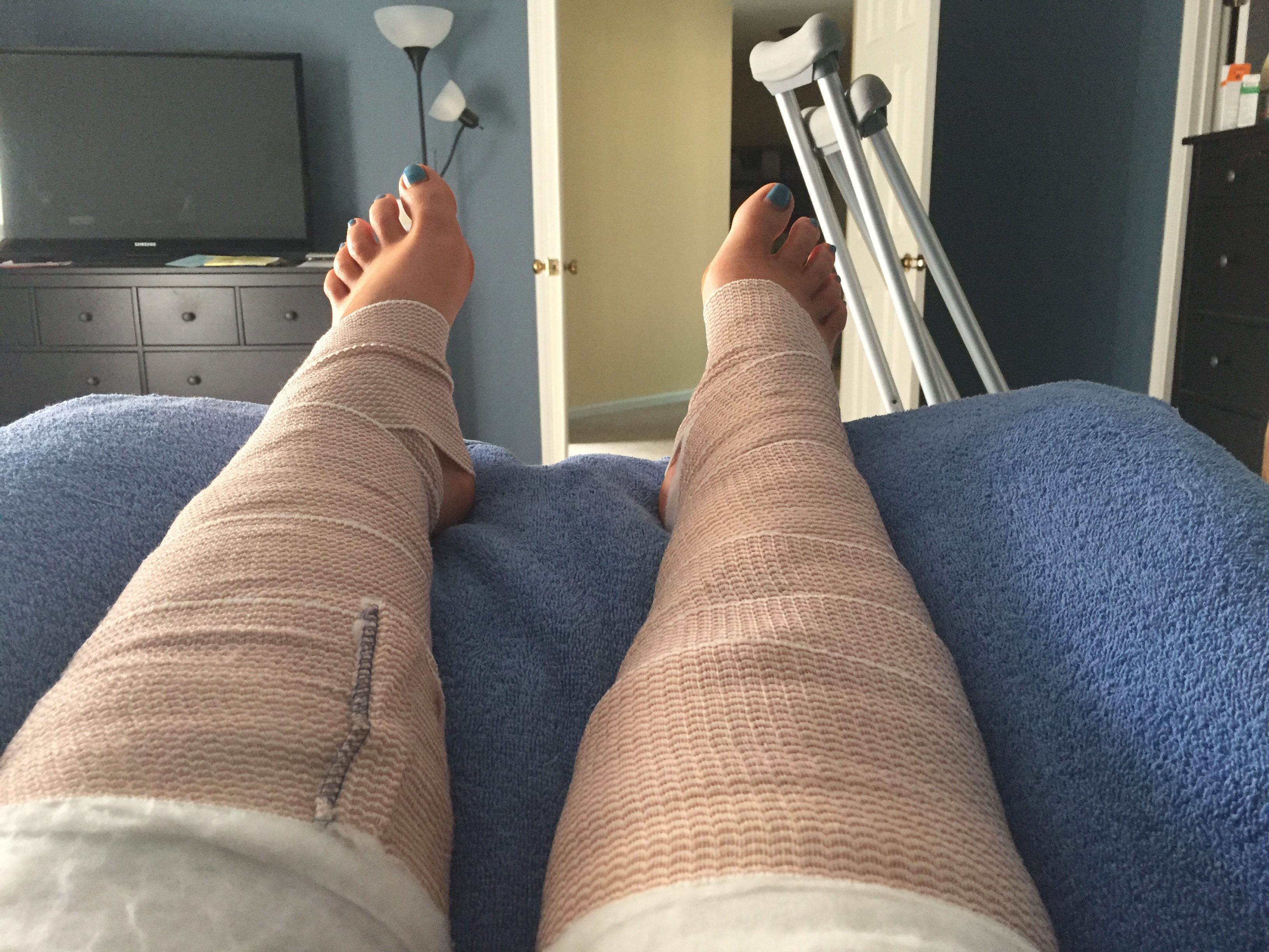 Personal Story What Is Compartment Syndrome Mandi Mitchell